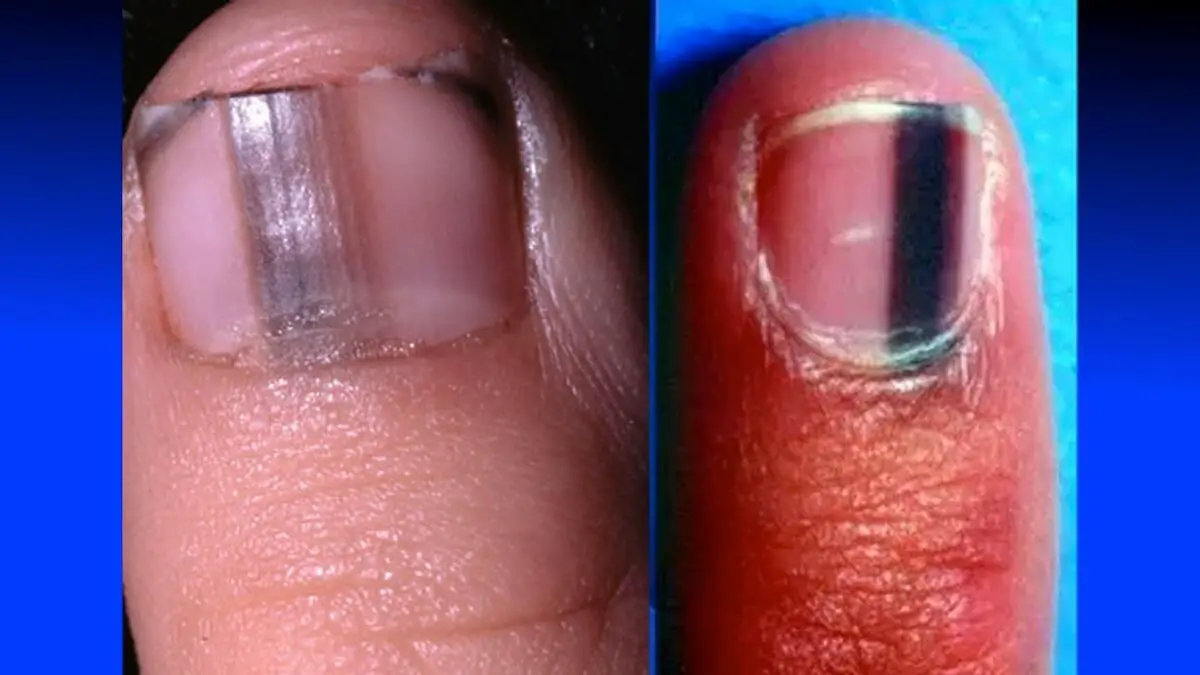 If You Ever Develop A Black Mark On Your Fingernail Like THIS Rush To 